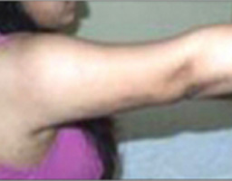 Liposuction