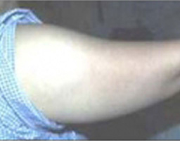 Liposuction