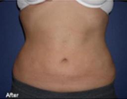 Liposuction