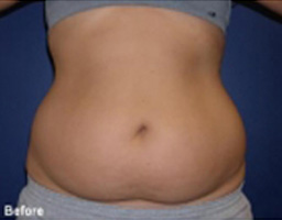 Liposuction