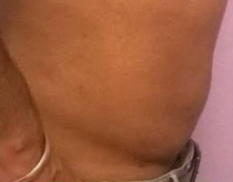 Liposuction
