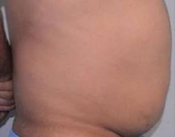 Liposuction