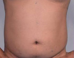 Liposuction