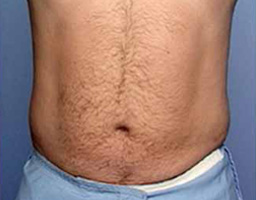 Liposuction