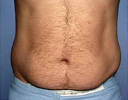 Liposuction