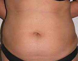 Liposuction