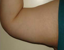 Liposuction