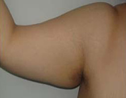 Liposuction