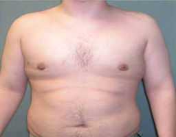 Male Breast Reduction