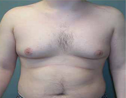 Male Breast Reduction