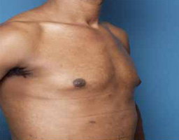 Male Breast Reduction