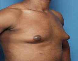 Male Breast Reduction