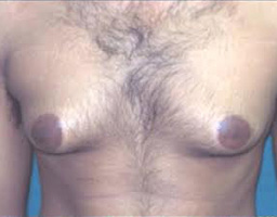 Male Breast Reduction