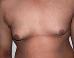 Male Breast Reduction