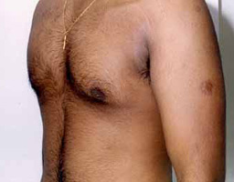 Male Breast Reduction