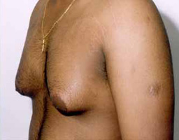 Male Breast Reduction