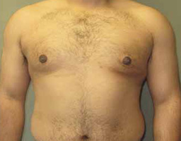 Male Breast Reduction