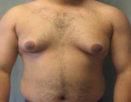 Male Breast Reduction