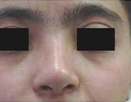 Nose Reshaping