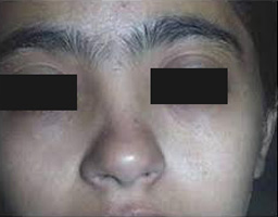 Nose Reshaping