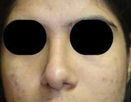 Nose Reshaping