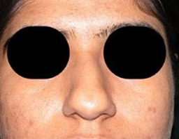 Nose Reshaping
