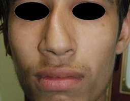 Nose Reshaping