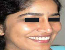 Nose Reshaping