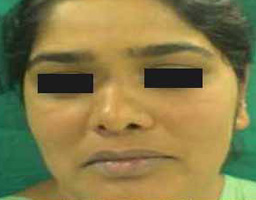 Nose Reshaping