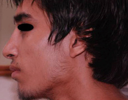Nose Reshaping