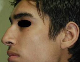 Nose Reshaping