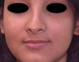 Nose Reshaping
