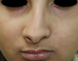 Nose Reshaping