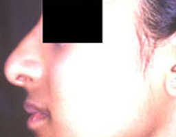Nose Reshaping