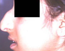Nose Reshaping