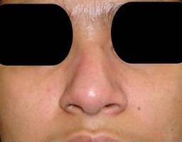 Nose Reshaping