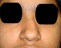 Nose Reshaping