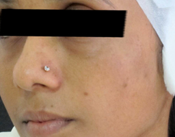 Pigmentation