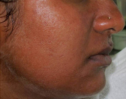 Pigmentation