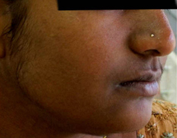 Pigmentation