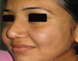 Pigmentation