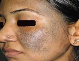 Pigmentation