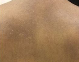 Pigmentation