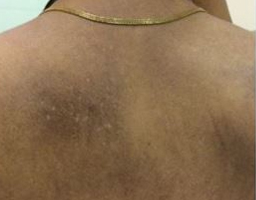 Pigmentation