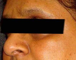 Pigmentation