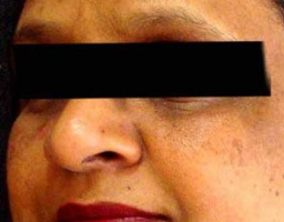 Pigmentation
