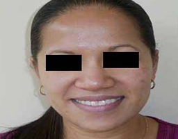 Pigmentation