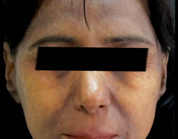 Pigmentation