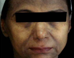 Pigmentation