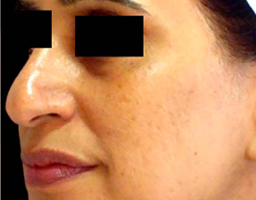 Pigmentation